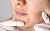 Liečba kožných problémov: krémy na akné, vrásky a strie
