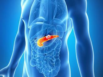 Karcinóm pankreasu: Zlá rakovina