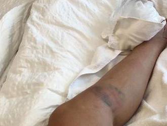 Vlhová uverejnila fotografiu zranenej nohy. Aj dôkaz, že nespadla z motorky