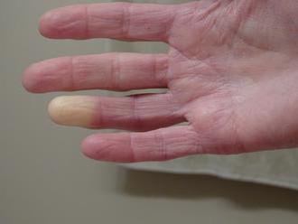 Trápí vás v chladném období studené ruce a nohy měnící barvu? Možná trpíte Raynaudovou nemocí!