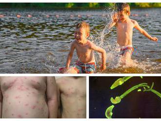 Poplach v Česku: FOTO Deti sa kúpali v rybníku, do kože im zaliezli larvy, bolestivá reakcia!