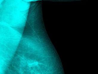 Lékaři potvrdili první přenos rakoviny prsu skrze transplantaci