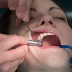 Jaké zubní výplně jsou hrazeny z veřejného zdravotního pojištění od 1. ledna 2019?