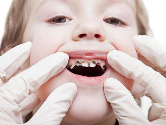 Zubný kaz u detí a jeho príčiny