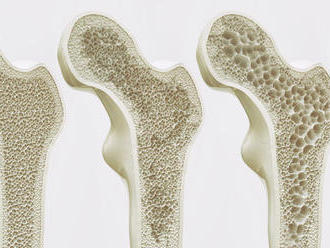 Otázky a odpovede o osteoporóze