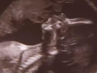 Tehotná žena   bola na ultrazvuku: FOTO bábätka ju úplne dorazila, vidíte TO v hornom rohu?