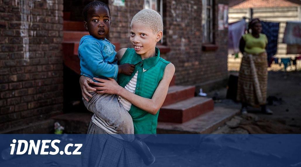 Češka vymyslela opalovací krémy pro africké albíny, mohou zachránit život