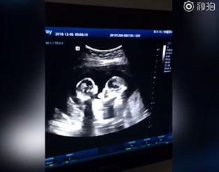 VIDEO Otec nakrúcal ultrazvuk svojej tehotnej manželky: Veď tie dvojičky sa bijú v maternici!