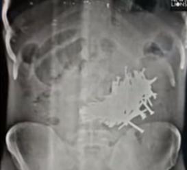 VIDEO Muža   bolelo brucho, röntgen odhalil šokujúcu príčinu: Toto mu našli v bruchu