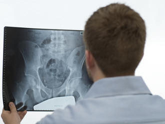 Veľký omyl o osteoporóze, o ktorom sa hovorí dlhé roky: Títo ľudia sa musia mať na pozore!