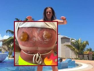 FOTO Tínedžerka sa potápala na dovolenke, skončila s obrím hnusom na chrbte: To nechcete vidieť!