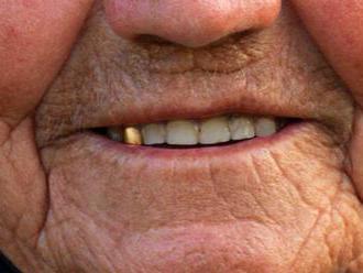 Zlaté zuby sú už minulosťou, nahrádzajú ich moderné materiály