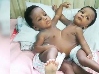 Nigerijskí lekári oddelili siamské dvojčatá zrastené bruchom