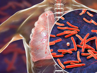 Pre pandémiu covidu je vo svete znova na vzostupe tuberkulóza