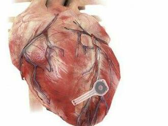 Vedci predstavili prototyp kardiostimulátora, ktorý sa v tele sám rozloží
