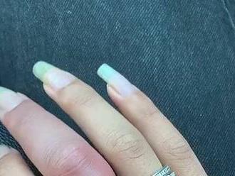 Žena zverejnila fotku, z ktorej vám príde zle: Aha, čo dokáže prsteň spôsobiť v lete!