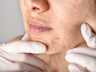 Liečba kožných problémov: krémy na akné, vrásky a strie