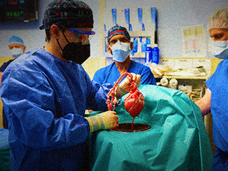 První pacient na světě dostal modifikované prasečí srdce