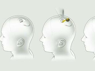 Muskova firma Neuralink bude ľuďom do mozgov implantovať čipy. Dostala zelenú od americkej FDA