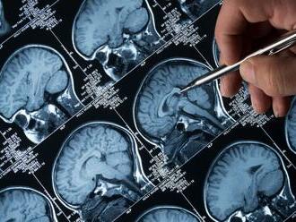 Nový liek na Alzheimera? Výskum priniesol prekvapivé výsledky! TOTO môže pomôcť
